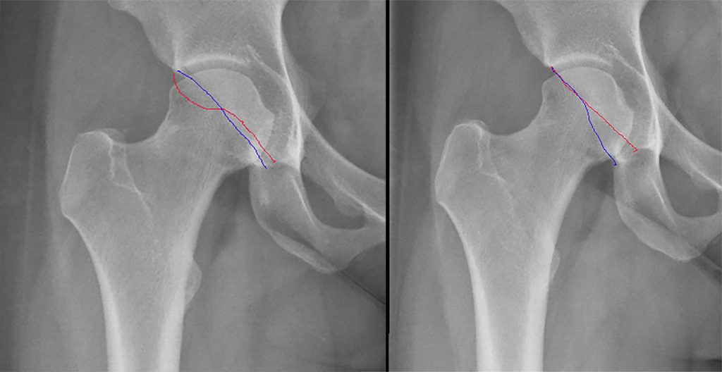 Voorbeeld van een pincer impingement, het cross-over sign (achterwand en voorwand) is aangegeven. Links voor en rechts na heuparthroscopie.